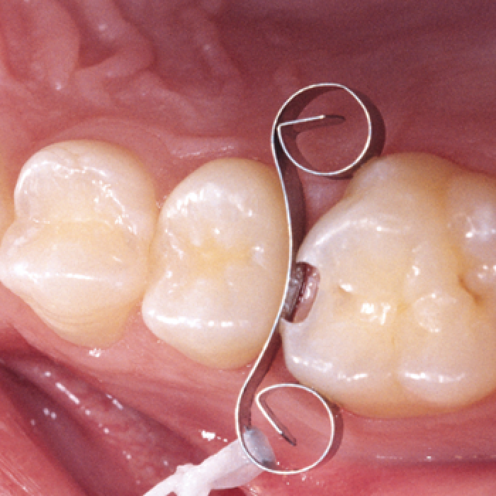 Ultradent Interguard Interproksimal Diş Koruyucu 