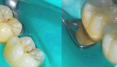 Rubber Dam Restoratif ve Endodontik Tedavilerin Vazgeçilmezi
